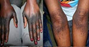 Dépigmentation : un marché toxique qui prospère sous l’inaction de l’État -